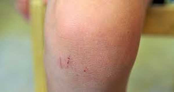 nguy-co-bi-hoai-tu-chi-vi-nhung-bat-can-khong-ai-ngo