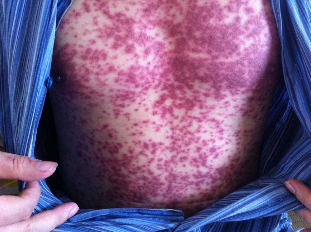 Lam-dung-thuoc-my-pham-khong-ro-nguon-goc-Coi-chung-hoi-chung-Steven-Johnson-2