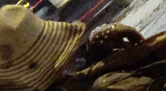 Bàn tay bị mưng mủ thực chất là giả