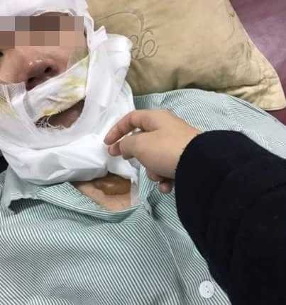 9X bi bong mat do no bong bay: Toi muon canh bao moi nguoi hinh anh 2