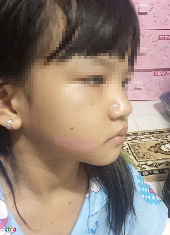 Cha be gai nghi bi di sat nong vao mat: 'Cho con thuong con' hinh anh 2