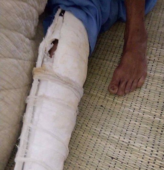 Con trai đánh bố đẻ gãy xương sườn, mẻ xương bánh chè, xương ống chân - Ảnh 2.