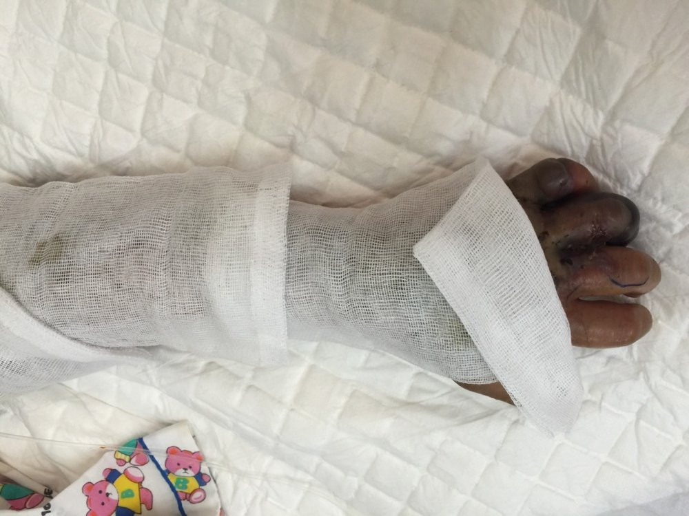 hinh_anh_ban_tay_trai_bi_hoai_tu