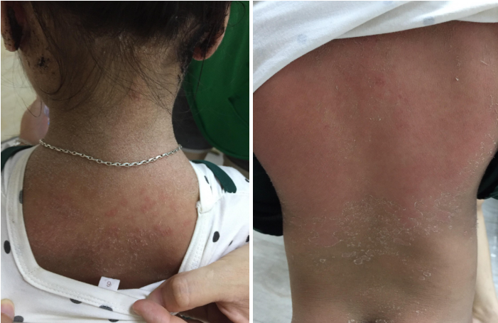 benh nhi bong choc da