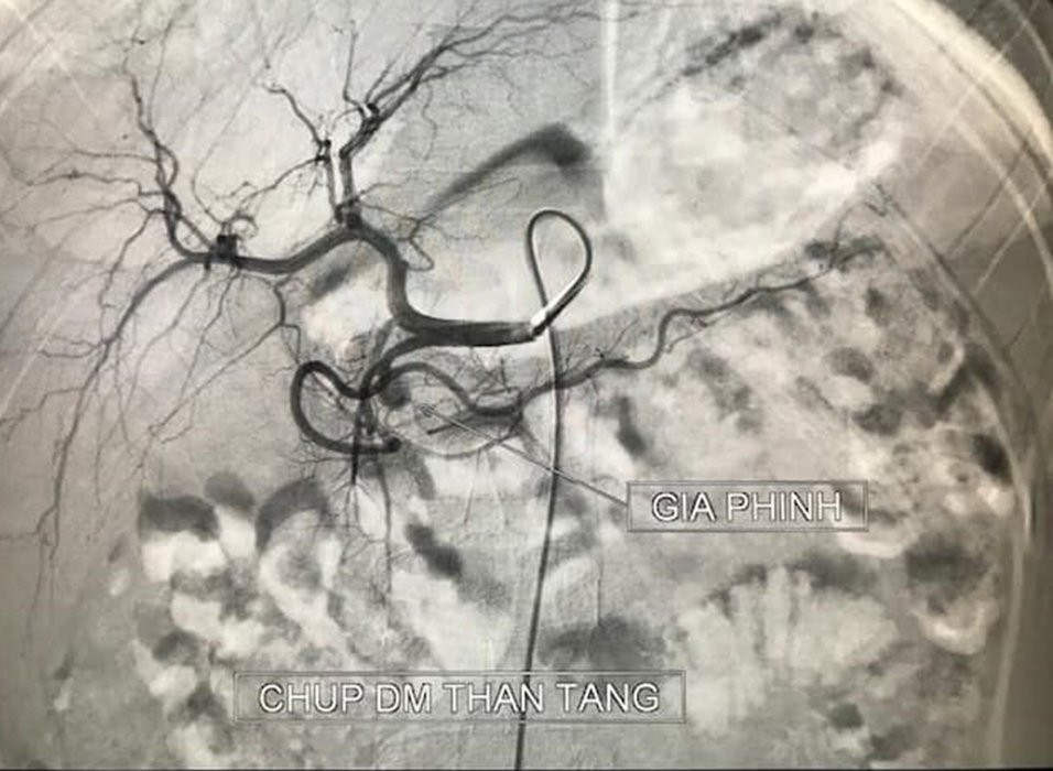 hinh anh phinh ta trang