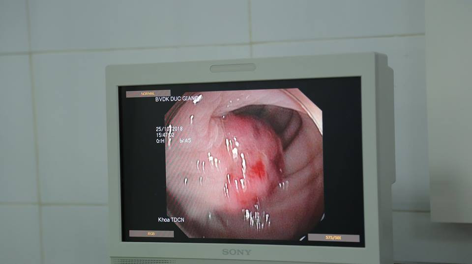 polyp benh nhan