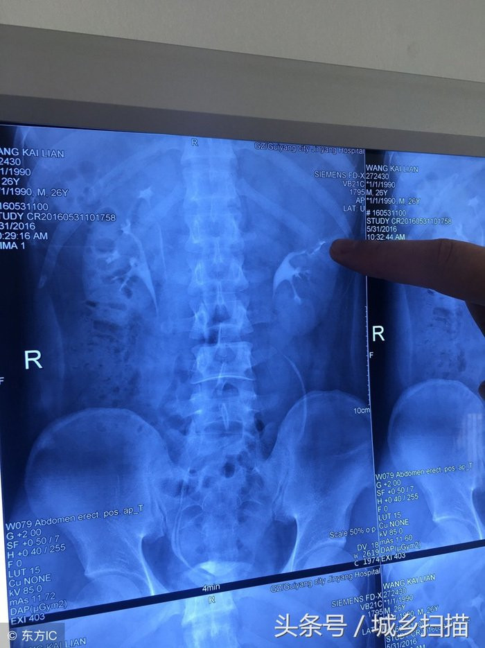 Nam thanh niên uống rượu thay nước lọc, đi khám phát hiện có 4 quả thận