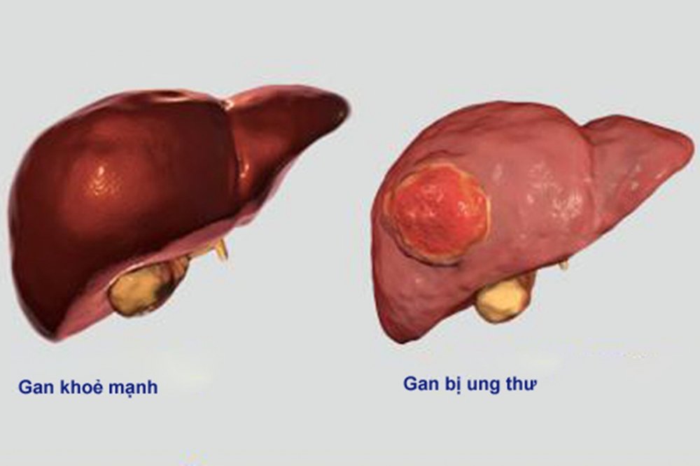 ung thu gan 1