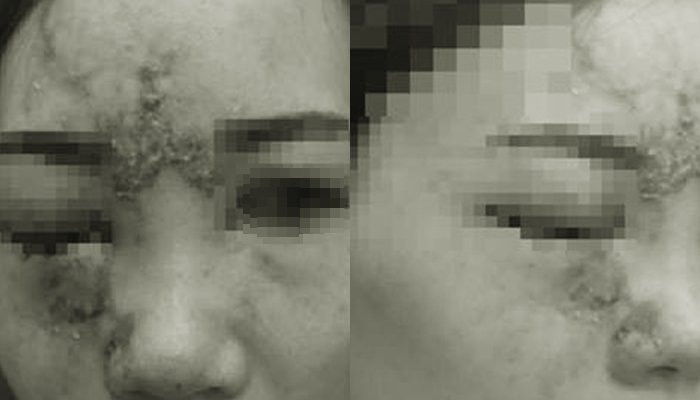 benh nhan mu mat vi tiem filler