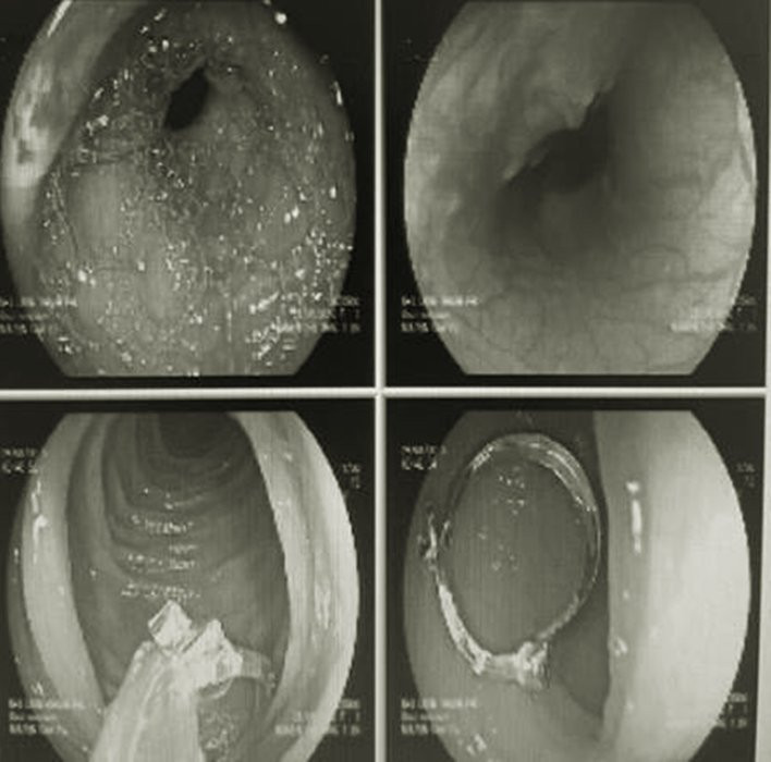 khuyen tai trong da day