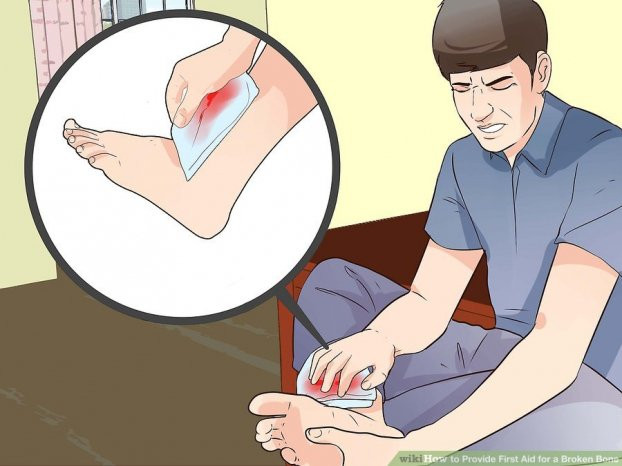 Kỹ năng sơ cứu: Cách sơ cứu khi bị gãy xương nhanh và an toàn nhất 3
