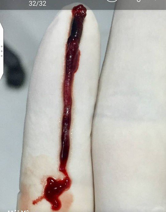 lay-duoc-cuc-mau-dong-gay-dot-quy-dai-10-cm