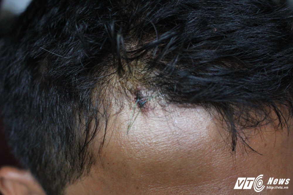 Hinh anh Bi danh chan thuong dau vi nhac nho bao ve dan pho di xe nguoc chieu?