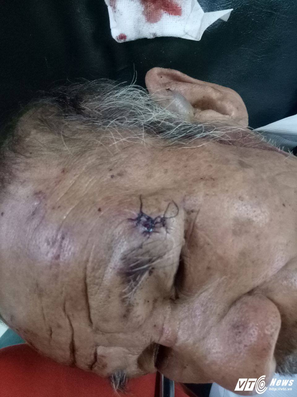 Hinh anh Nghich tu danh cha nhap vien o Binh Duong: Sang hat chen com, danh sung dau; chieu lai vac dao doi chem cha 3