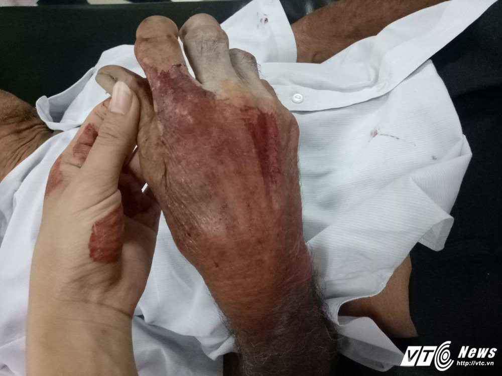 Hinh anh Nghich tu danh cha nhap vien o Binh Duong: Sang hat chen com, danh sung dau; chieu lai vac dao doi chem cha 4