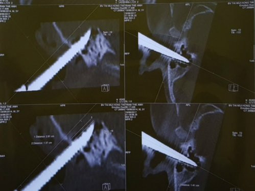 Mui-keo-cam-vao-tai-5418-1497953145