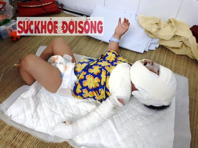 be-gai-9-thang-tuoi-nga-vao-bep-lua-khien-mat-bien-dang1498041365