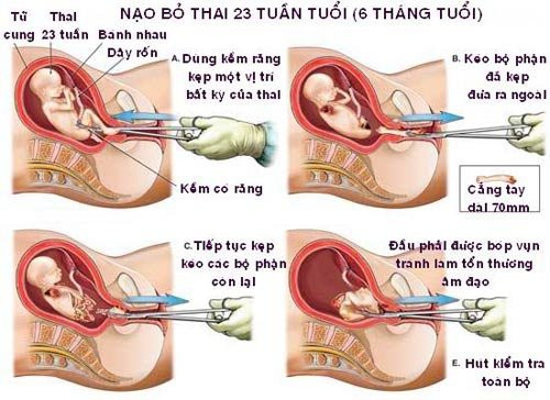 70-so-ca-nao-pha-thai-chiu-o-tuoi-vi-thanh-nien-2 3