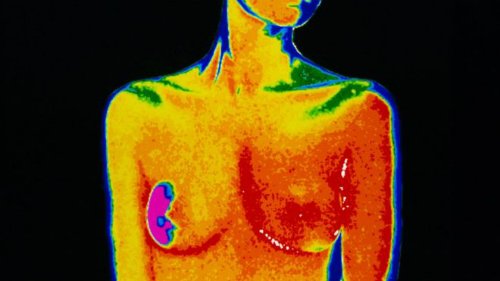 98681528-m1220433-breast-cance-4737-5000-1510541820