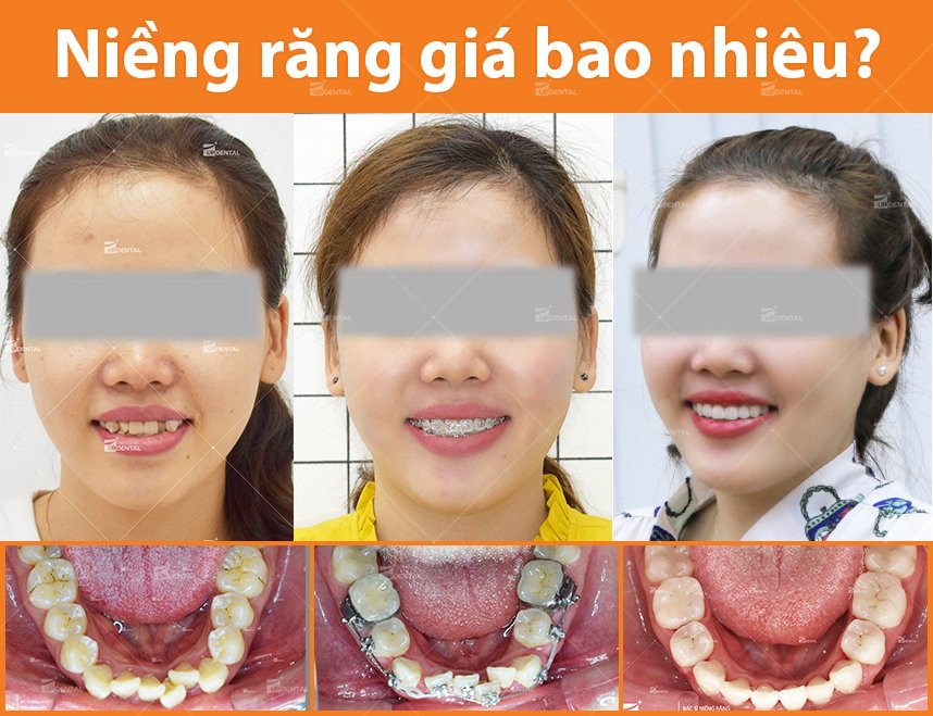 1-nieng-rang-gia-bao-nhieu-tien