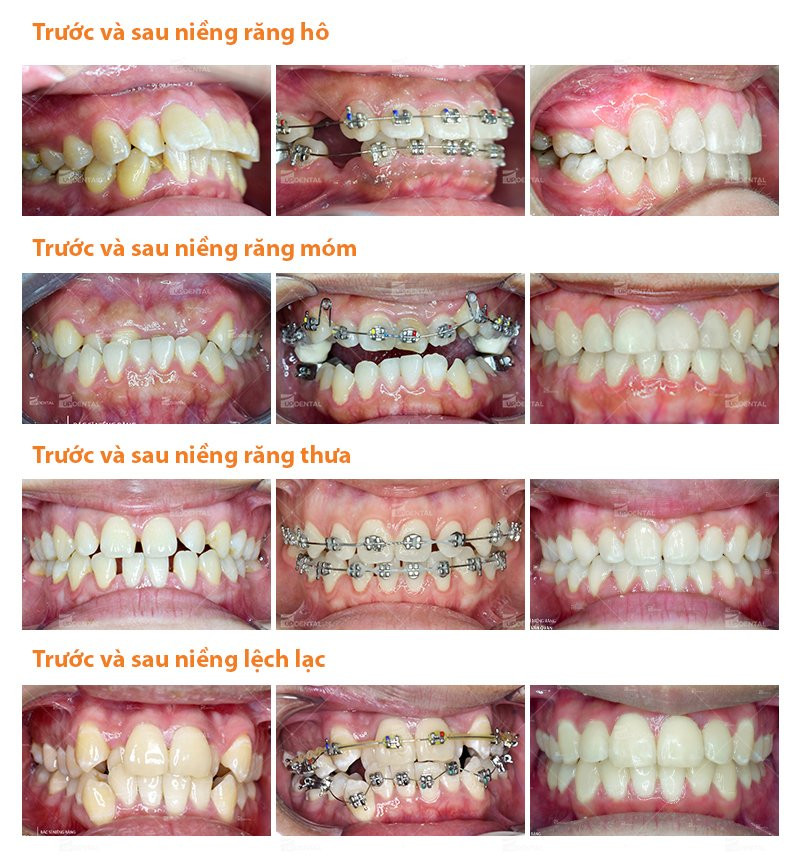 3-nieng-rang-gia-bao-nhieu-tien 3