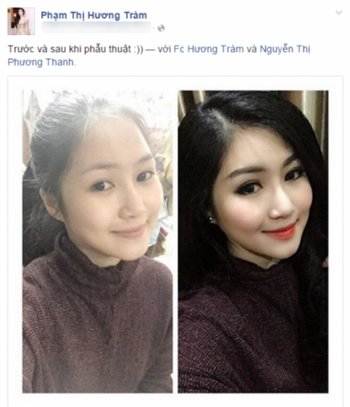 Sau loạt hình ảnh Hương Tràm đi phẫu thuật thẩm mỹ bị phát tán, giọng ca xứ Nghệ thừa nhận đã đi phẫu thuật chỉnh sửa mũi để phù hợp với tướng mạo