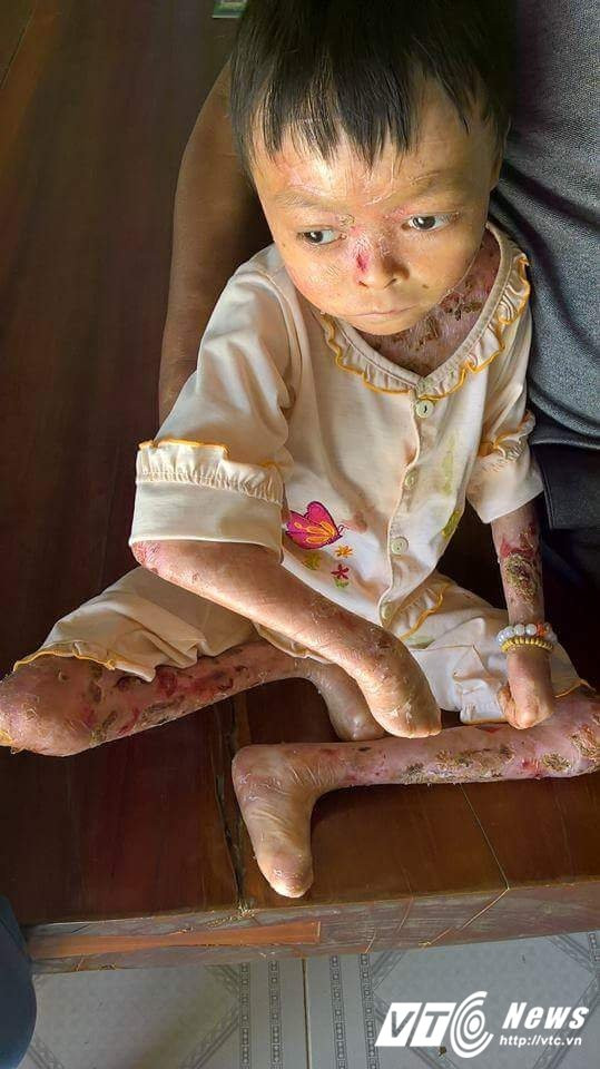 Hinh anh Xot thuong be 8 tuoi song canh lot da