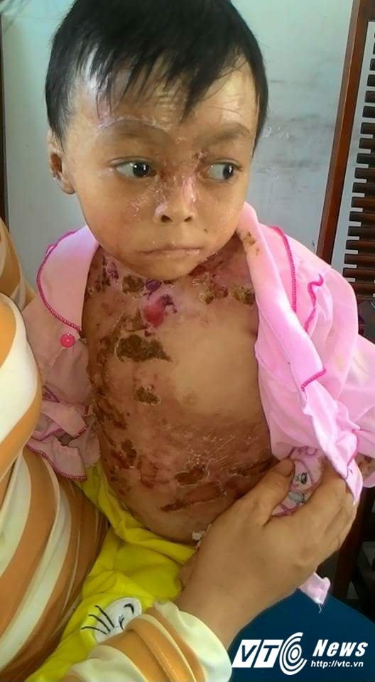 Hinh anh Xot thuong be 8 tuoi song canh lot da 4