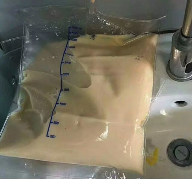 nguoi-dan-ong-37-tuoi-suyt-tu-vong-vi-viem-tuy-bac-si-canh-bao-6-dieu-cam-ky-1