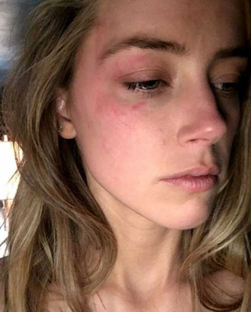 Amber Heard gửi ảnh làm bằng chứng chồng ném điện thoại vào mặt cô hôm 21/5.