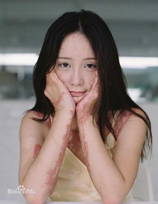 Nguoi mau teen tung bi thieu song vi tinh lo dien sau 5 nam hinh anh 1