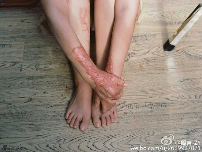 Nguoi mau teen tung bi thieu song vi tinh lo dien sau 5 nam hinh anh 4