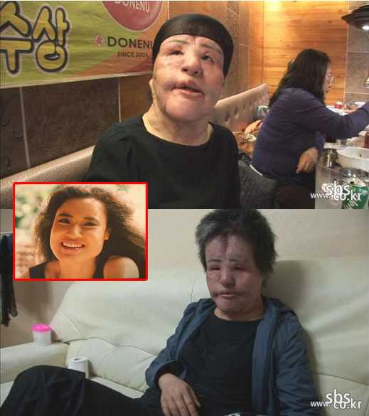 Một tai nạn phẫu thuật thẩm mỹ đáng sợ được nhắc đến nhiều nhất là nghệ sĩ Han Mi Ok. Nghiện bơm botox, cô đã hủy hoại hoàn toàn khuôn mặt mình, khiến nó trở nên biến dạng. 