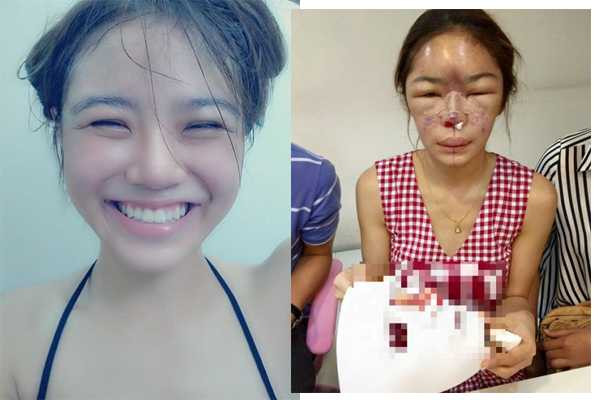 Hot girl Thái Lan Tawanrat Fah Chaiamnuay mới đây đăng bức ảnh cô sửa mặt quá đá, khiến nó trở nên dị dạng. Việc dị ứng silicon khiến mặt cô gái xinh đẹp (ảnh trái) ban đầu xuất hiện những chỗ sưng phồng, đỏ tấy, sau đó tình trạng ngày càng trở nên tệ hơn. 