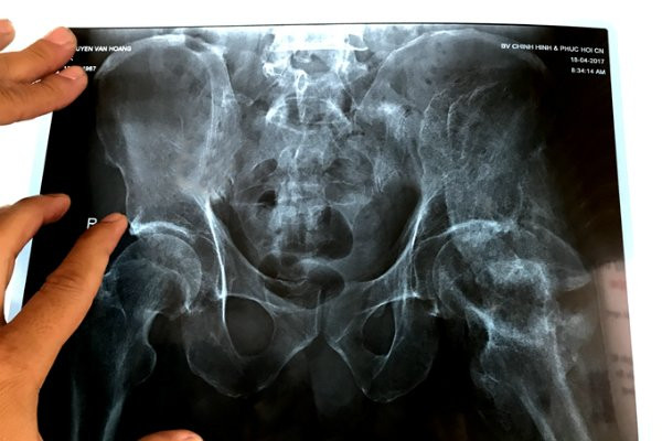 nguyen-hoang-nhap-vien-do-chan-bi-hoa-thach-1