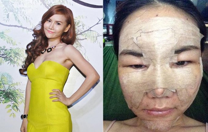 nhung-sao-viet-tung-cong-khai-qua-trinh-phau-thuat-thm-my-3