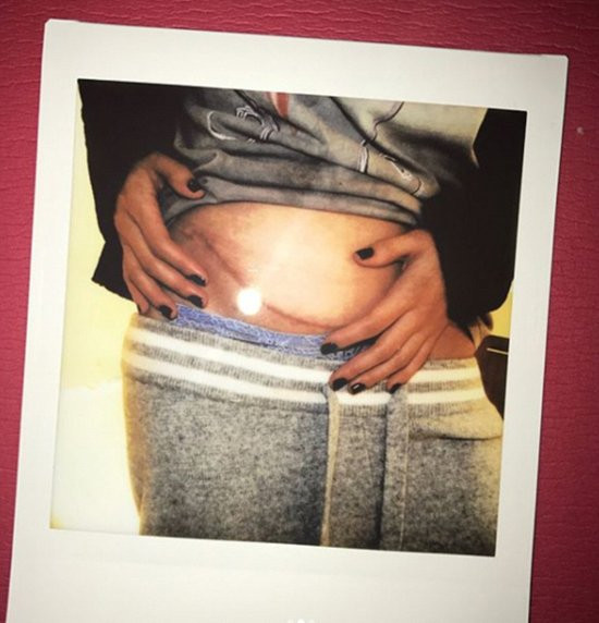 Ngoài ra, Selena còn có vết sẹo dài ở bụng dưới bên phải khi ghép thận.