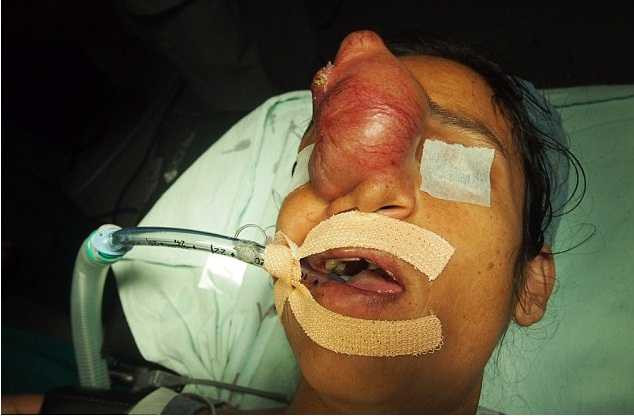 phau thuat khoi u tren mat