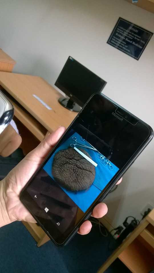 Khối bướu trên lưng bé T. khi được bóc tách