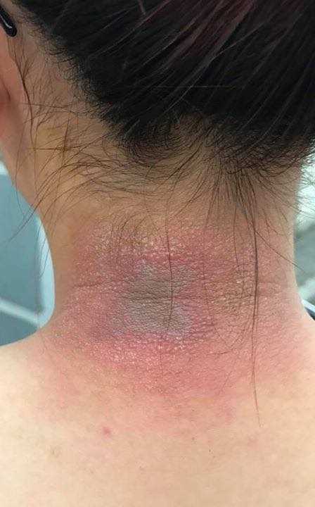 Khi da bị chất độc kiến làm tổn thương gây khó chịu không nên cào, gãi lên vết thương càng làm da bị bội nhiễm tạo thành mủ, sốt. Ảnh: TG
