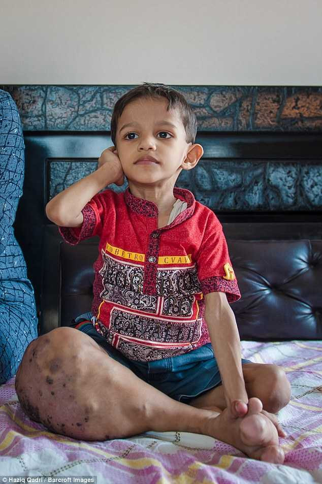 Mắc chứng bệnh hiếm gặp, cậu bé có chân to gấp 4 lần bình thường - Ảnh 2