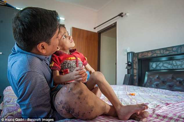 Mắc chứng bệnh hiếm gặp, cậu bé có chân to gấp 4 lần bình thường - Ảnh 4