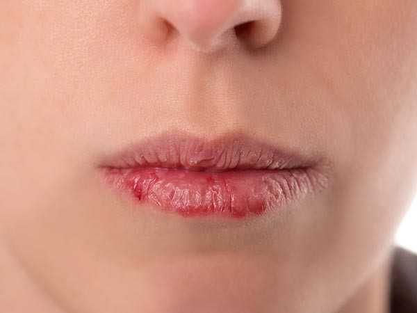 Khô môi vừa gây khó chịu vừa làm mất tự tin khi giao tiếp. Ảnh minh họa