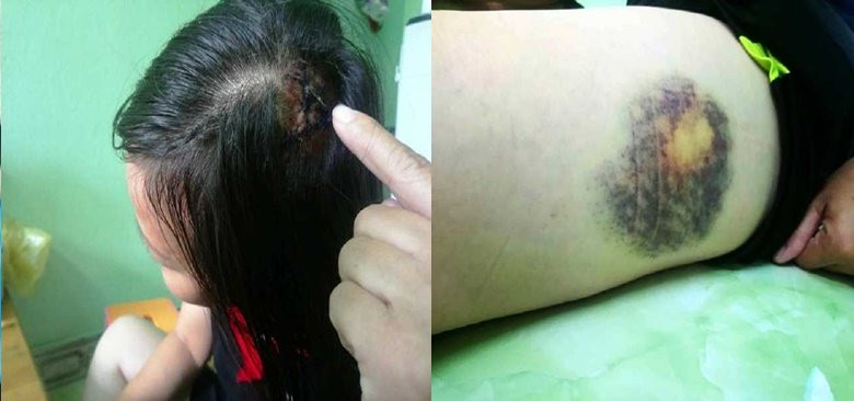 bao ve BV Hue bi to danh nguoi