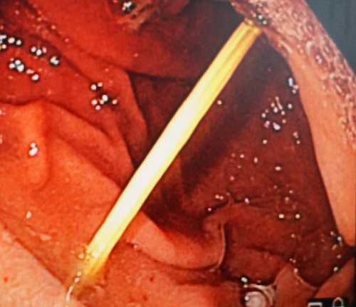 Người phụ nữ phát hoảng khi tăm tre dài 7cm nằm trong bụng - 1