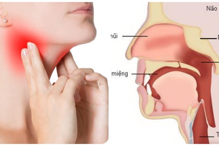 Bệnh ung thư vòm họng  dấu hiêu triệu chứng và cách điều tr