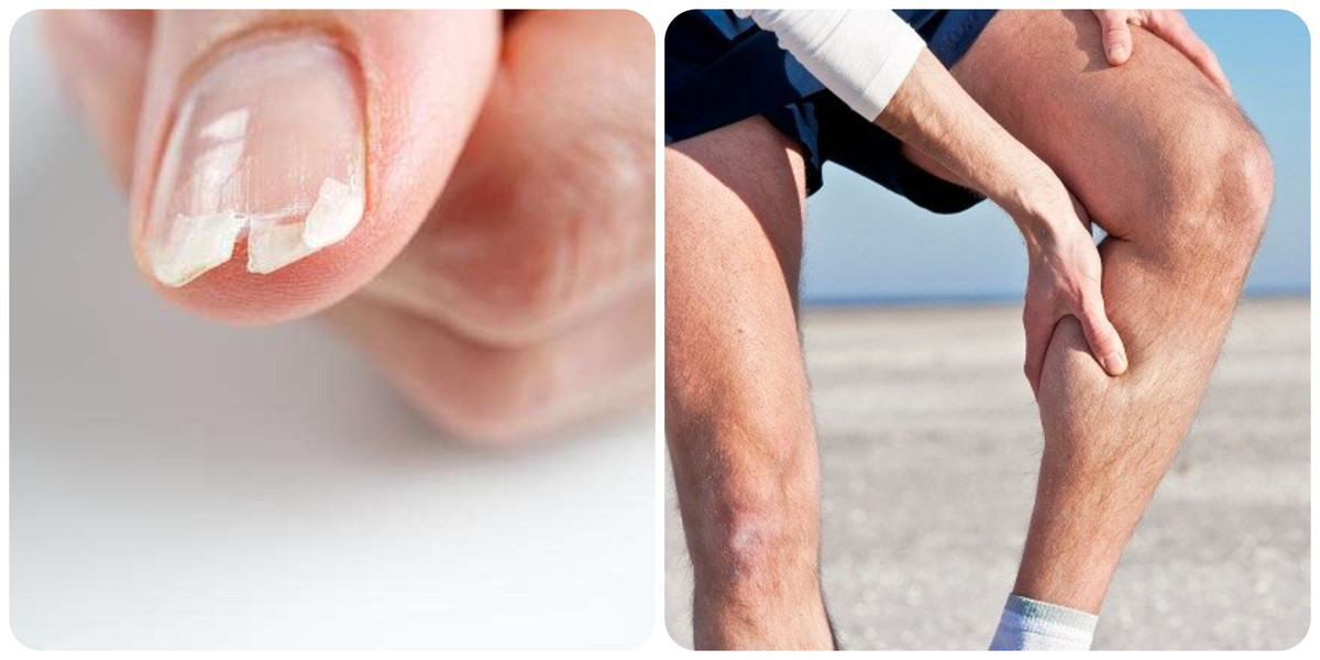 7 dấu hiệu thiếu canxi mọi người nên biết