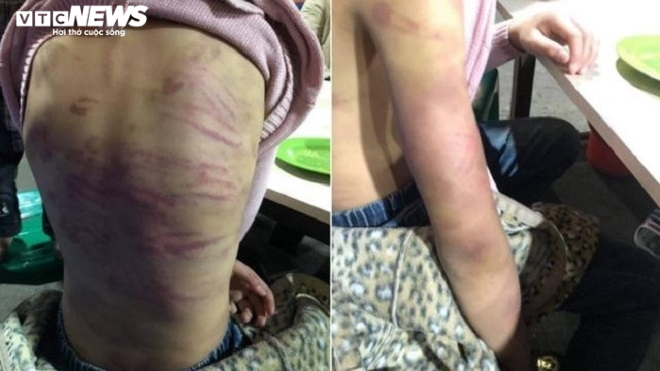 Bé gái 12 tuổi nghi bị bạo hành, xâm hại tình dục ở Hà Nội