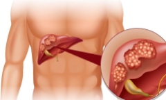 Triệu chứng ung thư tuyến tuỵ giai đoạn cuối