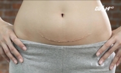 Chửa trên vết mổ: Bệnh lý nguy hiểm có thể cướp đi sinh mạng của bà bầu bất cứ lúc nào